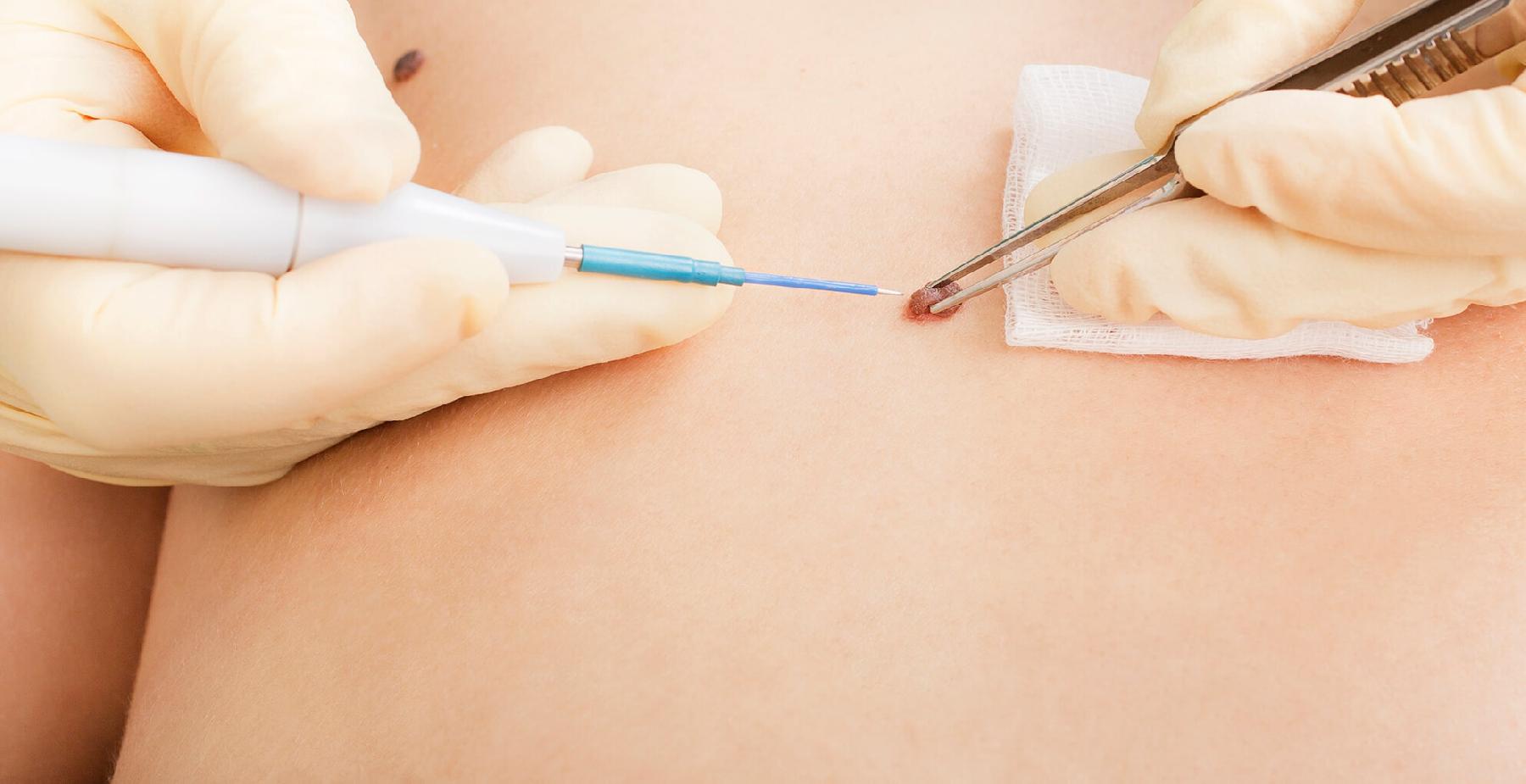 OPERATIVE DERMATOLOGIE